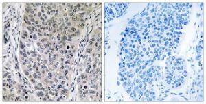 Immunohistochemical analysis of paraffin-embedded human lung carcinoma tissue using Anti-BRP16 Antibody. The right hand panel represents a negative control, where the antibody was pre-incubated with the immunising peptide