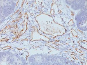 Immunohistochemical analysis of formalin-fixed, paraffin-embedded colon carcinoma using Anti-CD31 Antibody [C31.3 + C31.7 + C31.10]