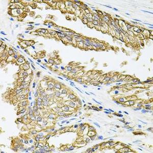 Immunohistochemistry analysis of paraffin-embedded human prostate using Anti-HLA-DQA1 Antibody (A9002) at a dilution of 1:100 (40X lens). Perform microwave antigen retrieval with 10 mM PBS buffer pH 7.2 before commencing with IHC staining protocol