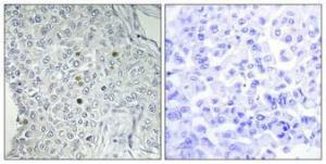 Immunohistochemical analysis of paraffin-embedded human breast cancer using Anti-REQU Antibody 1:100 (4°C overnight). The right hand panel represents a negative control, where the antibody was pre-incubated with the immunising peptide