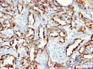 Immunohistochemical analysis of formalin-fixed, paraffin-embedded angiosarcoma using Anti-CD31 Antibody [C31.3 + C31.7 + C31.10]