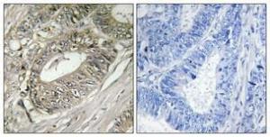 Immunohistochemical analysis of paraffin-embedded human colon cancer using Anti-ARFGEF2 Antibody 1:100 (4°C overnight). The right hand panel represents a negative control, where the antibody was pre-incubated with the immunising peptide