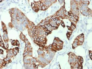 Immunohistochemical analysis of formalin-fixed, paraffin-embedded human colon carcinoma using Anti-Cytokeratin 20 Antibody [KRT20/1993]