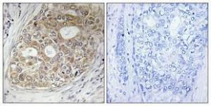 Immunohistochemical analysis of paraffin-embedded human breast cancer using Anti-ARFGAP1 Antibody 1:100 (4°C overnight). The right hand panel represents a negative control, where the antibody was pre-incubated with the immunising peptide