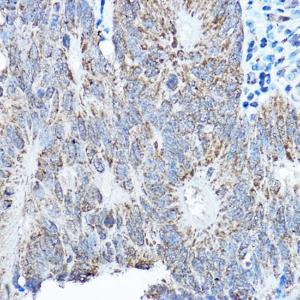 Immunohistochemistry analysis of paraffin-embedded human colon carcinoma tissue using Anti-SMOC1 Antibody (A306232) at a dilution of 1:200 (40x lens)