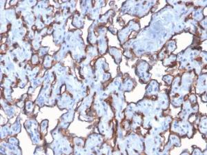 Immunohistochemical analysis of formalin-fixed, paraffin-embedded human angiosarcoma using Anti-CD31 Antibody [C31/2876R]