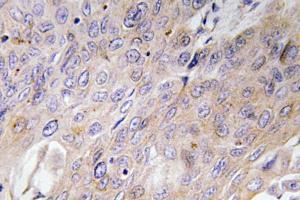 Immunohistochemical analysis of paraffin-embedded human lung carcinoma tissue using Anti-BMP-3 Antibody