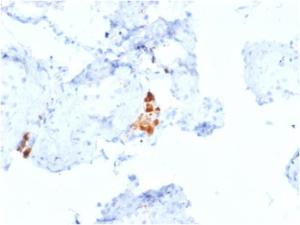 Immunohistochemical analysis of formalin-fixed, paraffin-embedded human testicular carcinoma using Anti-Calretinin Antibody [CALB2/2807]