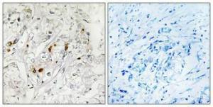 Immunohistochemical analysis of paraffin-embedded human breast cancer using Anti-MSK1 Antibody 1:100 (4°C overnight). The right hand panel represents a negative control, where the antibody was pre-incubated with the immunising peptide.