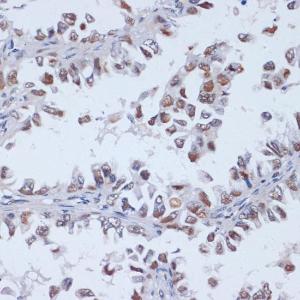 Immunohistochemistry analysis of paraffin-embedded human lung cancer using Anti-Dnmt3L Antibody (A9041) at a dilution of 1:100 (40X lens). Perform microwave antigen retrieval with 10 mM PBS buffer pH 7.2 before commencing with IHC staining protocol