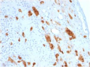 Immunohistochemical analysis of formalin-fixed, paraffin-embedded human mesothelioma using Anti-Calretinin Antibody [CALB2/2807]