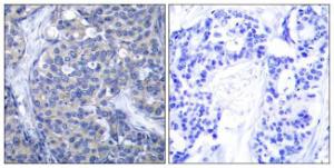 Immunohistochemical analysis of paraffin-embedded human breast carcinoma tissue using Anti-ZAP-70 Antibody. The right hand panel represents a negative control, where the antibody was pre-incubated with the immunising peptide