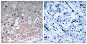 Immunohistochemical analysis of paraffin-embedded human breast carcinoma tissue using Anti-VEGFR2 Antibody. The right hand panel represents a negative control, where the antibody was pre-incubated with the immunising peptide