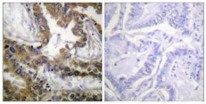 Immunohistochemical analysis of paraffin-embedded human lung carcinoma tissue using Anti-VEGFR2 Antibody. The right hand panel represents a negative control, where the antibody was pre-incubated with the immunising peptide