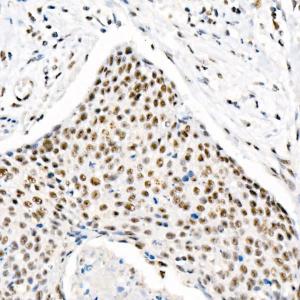 Immunohistochemistry analysis of paraffin-embedded human cervix cancer tissue using Anti-Chk2 (phospho Thr68) Antibody [ARC58395] (A309132) at a dilution of 1:1,000 (40x lens). Perform high pressure antigen retrieval with 10 mM citrate buffer pH 6.0 before commencing with IHC staining protocol.