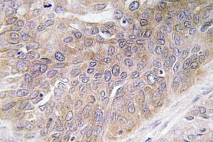 Immunohistochemical analysis of paraffin-embedded human lung carcinoma tissue using Anti-VEGF-D Antibody