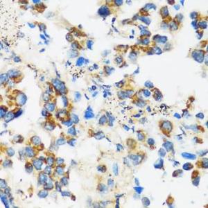 Immunohistochemistry analysis of paraffin-embedded human lung cancer using Anti-APOBEC3F Antibody (A9054) at a dilution of 1:100 (40X lens). Perform microwave antigen retrieval with 10 mM PBS buffer pH 7.2 before commencing with IHC staining protocol