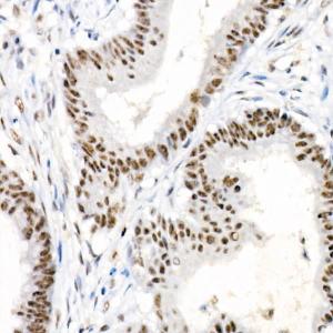 Immunohistochemistry analysis of paraffin-embedded human colon carcinoma tissue using Anti-Chk2 (phospho Thr68) Antibody [ARC58395] (A309132) at a dilution of 1:1,000 (40x lens). Perform high pressure antigen retrieval with 10 mM citrate buffer pH 6.0 before commencing with IHC staining protocol.