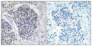 Immunohistochemical analysis of paraffin-embedded human lung cancer using Anti-JIP3 Antibody 1:100 (4°C overnight) The right hand panel represents a negative control, where the antibody was pre-incubated with the immunising peptide