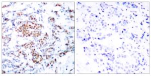 Immunohistochemical analysis of paraffin-embedded human breast carcinoma tissue using Anti-STAT5A Antibody. The right hand panel represents a negative control, where the antibody was pre-incubated with the immunising peptide