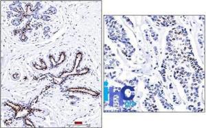 Immunohistochemical analysis of formalin-fixed, paraffin-embedded normal human breast (left) and invasive ductal carcinoma (right) using Anti-Progesterone Receptor Antibody [PR501]