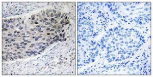 Immunohistochemical analysis of paraffin-embedded human lung carcinoma tissue using Anti-PC Antibody. The right hand panel represents a negative control, where the antibody was pre-incubated with the immunising peptide