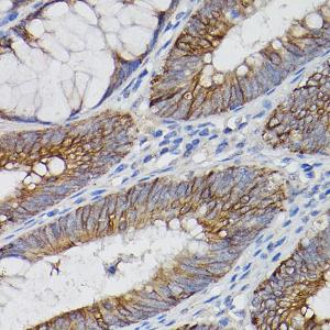 Immunohistochemistry analysis of paraffin-embedded human colon carcinoma tissue using Anti-IL-18R1 Antibody (A9075) at a dilution of 1:100 (40x lens). Perform high pressure antigen retrieval with 10 mM citrate buffer pH 6.0 before commencing with IHC staining protocol.