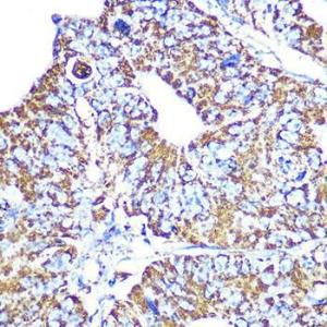 Immunohistochemistry analysis of paraffin-embedded human colon carcinoma tissue using Anti-HSP60 Antibody [ARC0260] (A309137) at a dilution of 1:100 (40x lens). Perform microwave antigen retrieval with 10 mM PBS buffer pH 7.2 before commencing with IHC staining protocol.