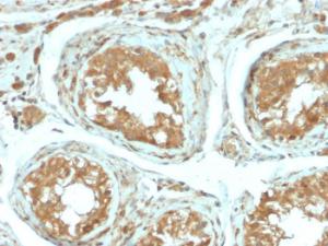 Immunohistochemical analysis of formalin-fixed, paraffin-embedded human testicular carcinoma using Anti-B7H4 Antibody [B7H4/2652R]