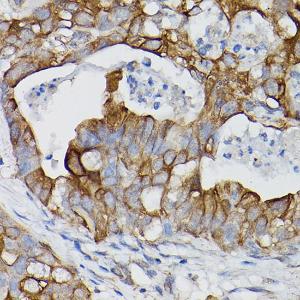 Immunohistochemistry analysis of paraffin-embedded human lung cancer using Anti-IL-18R1 Antibody (A9075) at a dilution of 1:100 (40x lens). Perform high pressure antigen retrieval with 10 mM citrate buffer pH 6.0 before commencing with IHC staining protocol.