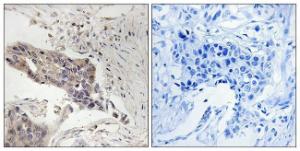 Immunohistochemical analysis of paraffin-embedded human breast carcinoma tissue using Anti-SLP-76 Antibody. The right hand panel represents a negative control, where the Antibody was pre-incubated with the immunising peptide