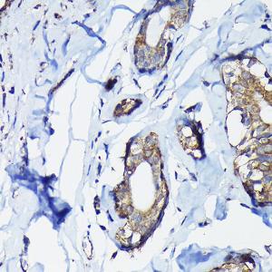 Immunohistochemistry analysis of paraffin-embedded human breast cancer tissue using Anti-PEG10 / EDR Antibody (A9086) at a dilution of 1:100 (40x lens). Perform high pressure antigen retrieval with 10 mM citrate buffer pH 6.0 before commencing with IHC staining protocol.