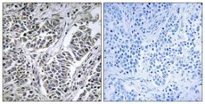 Immunohistochemical analysis of paraffin-embedded human lung carcinoma tissue using Anti-ATP5D Antibody. The right hand panel represents a negative control, where the Antibody was pre-incubated with the immunising peptide