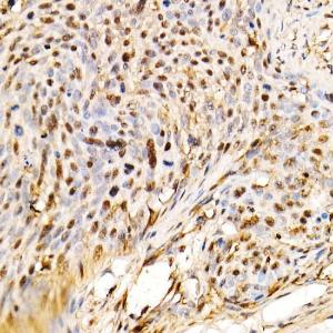 Immunohistochemistry analysis of paraffin-embedded human cervix cancer tissue using Anti-ERK1 + ERK2 Antibody [ARC0212] (A306245) at a dilution of 1:100 (40x lens). Perform high pressure antigen retrieval with 10 mM citrate buffer pH 6.0 before commencing with IHC staining protocol.