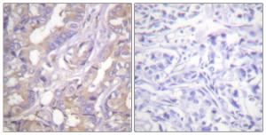 Immunohistochemical analysis of paraffin-embedded human breast carcinoma tissue using Anti-A-RAF Antibody. The right hand panel represents a negative control, where the antibody was pre-incubated with the immunising peptide.