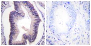 Immunohistochemical analysis of paraffin-embedded human colon carcinoma tissue using Anti-PFKFB2 Antibody. The right hand panel represents a negative control, where the antibody was pre-incubated with the immunising peptide