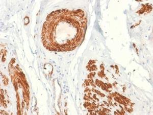 Immunohistochemical analysis of formalin-fixed, paraffin-embedded human leiomyosarcoma using Anti-Caldesmon Antibody [rCALD1/820]