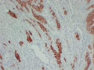 Immunohistochemical analysis of paraffin-embedded human Cutaneous squamous cell carcinoma using Anti-Cytokeratin 16 Antibody