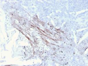 Immunohistochemical analysis of formalin-fixed, paraffin-embedded human lung carcinoma using Anti-Tenascin C Antibody [rTNC/3635]