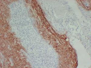 Immunohistochemical analysis of paraffin-embedded human Cutaneous squamous cell carcinoma using Anti-Cytokeratin 16 Antibody