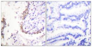 Immunohistochemical analysis of paraffin-embedded human lung carcinoma tissue using Anti-OCT3 Antibody. The right hand panel represents a negative control, where the antibody was pre-incubated with the immunising peptide