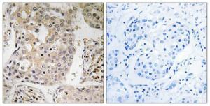 Immunohistochemical analysis of paraffin-embedded human breast carcinoma tissue using Anti-MRPL41 Antibody. The right hand panel represents a negative control, where the antibody was pre-incubated with the immunising peptide.