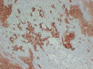 Immunohistochemical analysis of paraffin-embedded human Cutaneous squamous cell carcinoma using Anti-Cytokeratin 16 Antibody