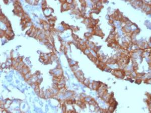 Immunohistochemical analysis of formalin-fixed, paraffin-embedded human ovarian carcinoma tissue using Anti-EpCAM Antibody [EGP40/1372] (HRP)