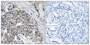 Immunohistochemical analysis of paraffin-embedded human breast carcinoma tissue using Anti-MRPL24 Antibody. The right hand panel represents a negative control, where the Antibody was pre-incubated with the immunising peptide