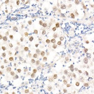 Immunohistochemistry analysis of paraffin-embedded human testicular seminoma using Anti-Nanog Antibody (A9165) at a dilution of 1:20 (40X lens). Perform high pressure antigen retrieval with 10 mM citrate buffer pH 6.0 before commencing with IHC staining protocol