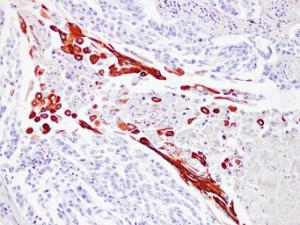 Immunohistochemical analysis of paraffin-embedded human Squamous cell lung carcinoma using Anti-Cytokeratin 16 Antibody