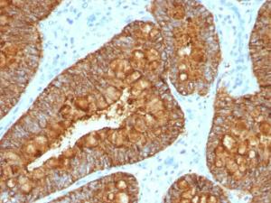 Immunohistochemical analysis of formalin-fixed, paraffin-embedded human colon carcinoma using Anti-MAML3 Antibody [MAML3/1303]