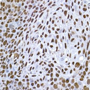 Immunohistochemistry analysis of paraffin-embedded human esophageal cancer using Anti-Histone H1.2 Antibody (A9176) at a dilution of 1:200 (40X lens). Perform high pressure antigen retrieval with 10 mM citrate buffer pH 6.0 before commencing with IHC staining protocol