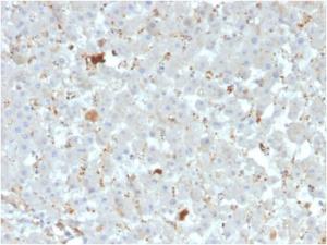 Immunohistochemical analysis of formalin-fixed, paraffin-embedded human liver carcinoma using Anti-APOA4 Antibody [APOA4/3372]